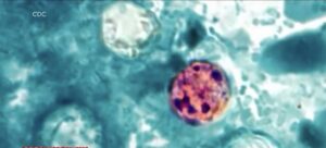 This microscopic image shows Cyclospora cayetanensis oocysts (the parasite that causes the diarrheal illness cyclosporiasis) in a stool sample, stained with safranin. Source: Melanie Moser / CDC