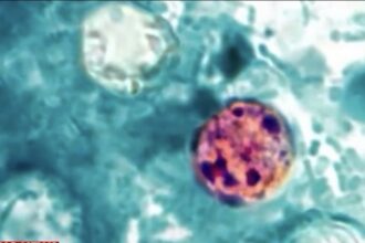 This microscopic image shows Cyclospora cayetanensis oocysts (the parasite that causes the diarrheal illness cyclosporiasis) in a stool sample, stained with safranin. Source: Melanie Moser / CDC